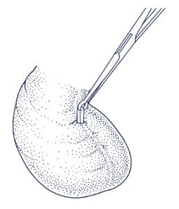 testicle image of vasectomy procedures