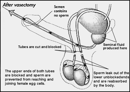 vasectomy cuts the sperm flow diagram sasatoon
