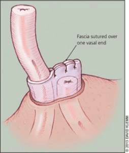 fascial interposition with vasectomy diagram