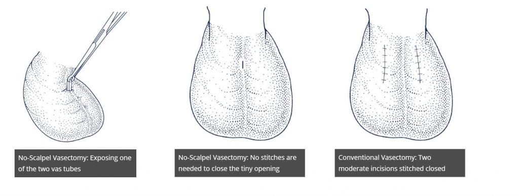 No scalpel, no needle vasectomy is a safe and painless procedure